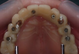 Gradual incorporation of the upper implants in the upper temporary bridge.