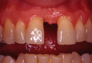 Huge natural diastema.