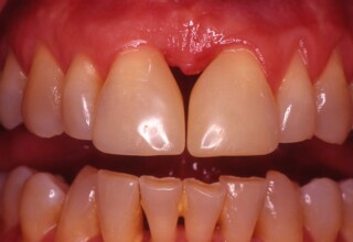 Initial Diastema closure up to 0.5mm.