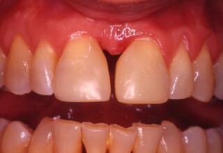 Recontouring to provide more natural shape to both central incisors by increasing diastema to 1mm.